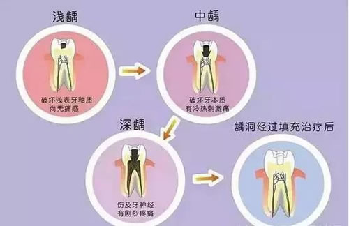 牙齿上小黑点的演化过程.jpg