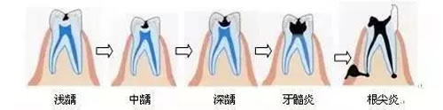 牙齿上小黑点的变化过程.jpg