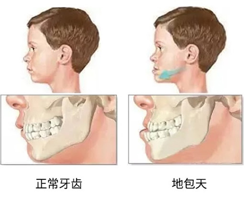 正常牙齿和地包天对比