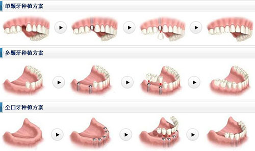 潍坊可恩口腔医院种植牙多少钱