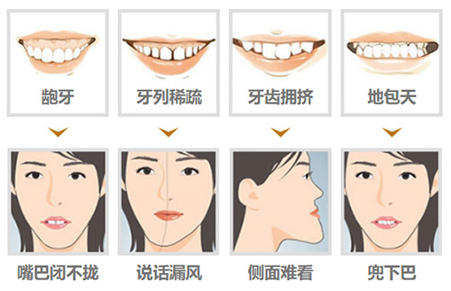 需要进行牙齿矫正的四种情况