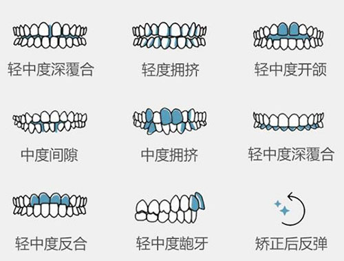 做牙齿矫正牙套贵吗?